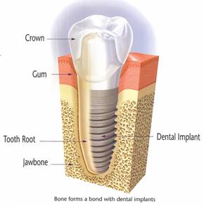 Teeth Implants - Dental Implant